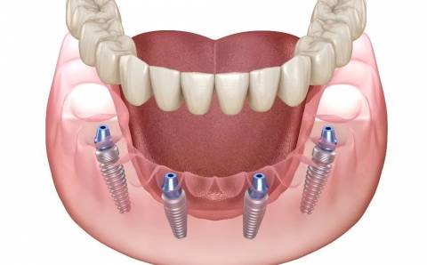 Viskas, ką reikia žinoti apie dantų atkūrimą ant 4 implantų