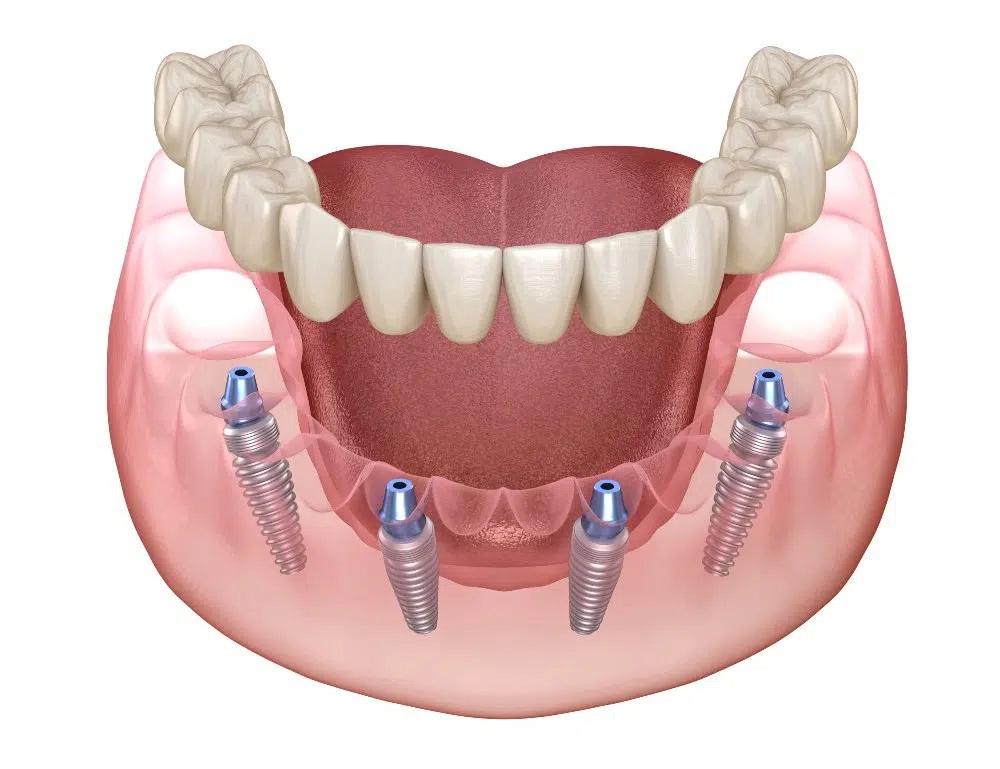 Viskas, ką reikia žinoti apie dantų atkūrimą ant 4 implantų